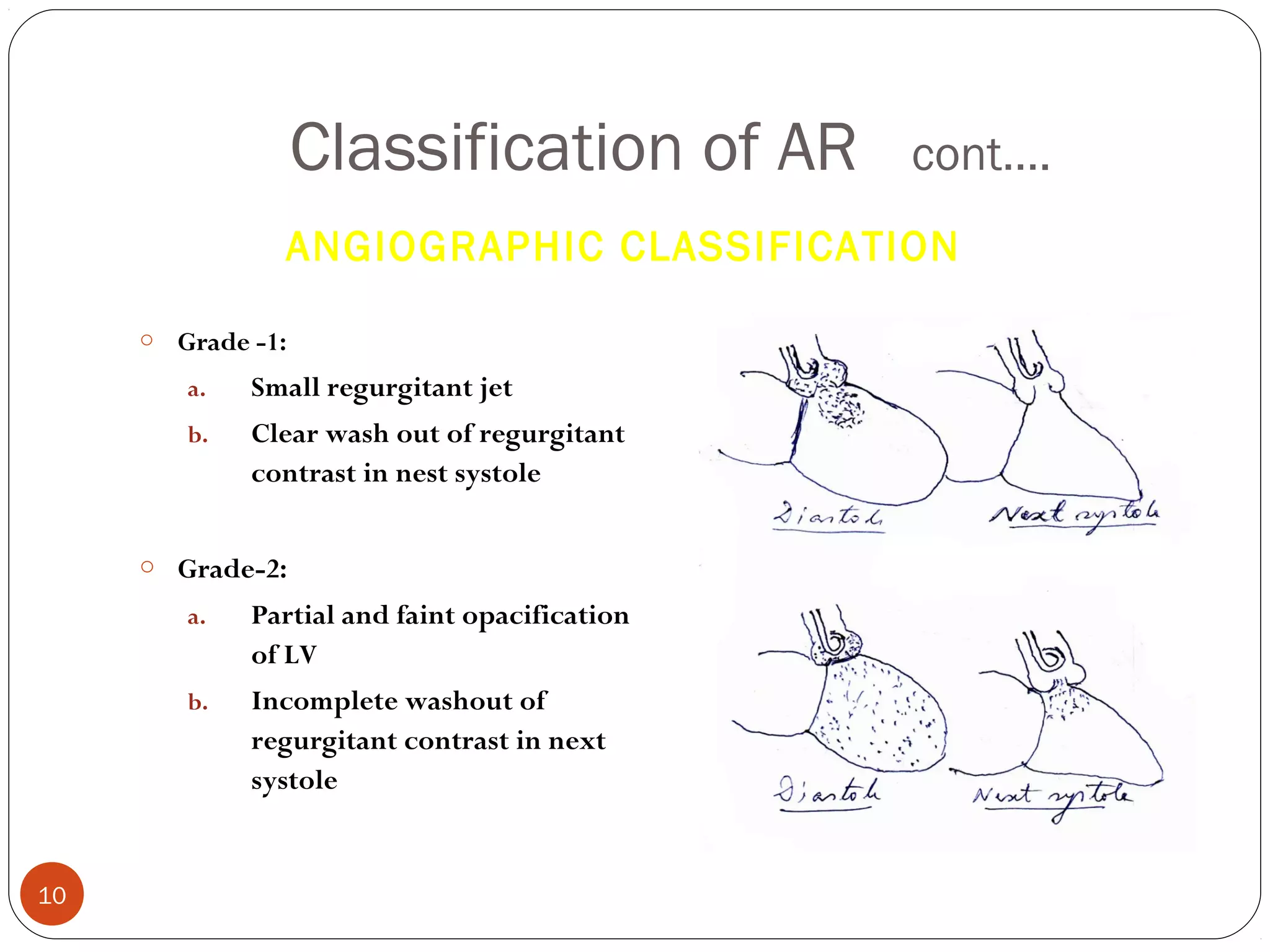 Classification of AR        cont….
               ANGIOGRAPHIC CLASSIFICATION

     o Grade -1:

        a.   Small regurgitant jet
        b.   Clear wash out of regurgitant
             contrast in nest systole


     o Grade-2:

        a.   Partial and faint opacification
             of LV
        b.   Incomplete washout of
             regurgitant contrast in next
             systole


10
 