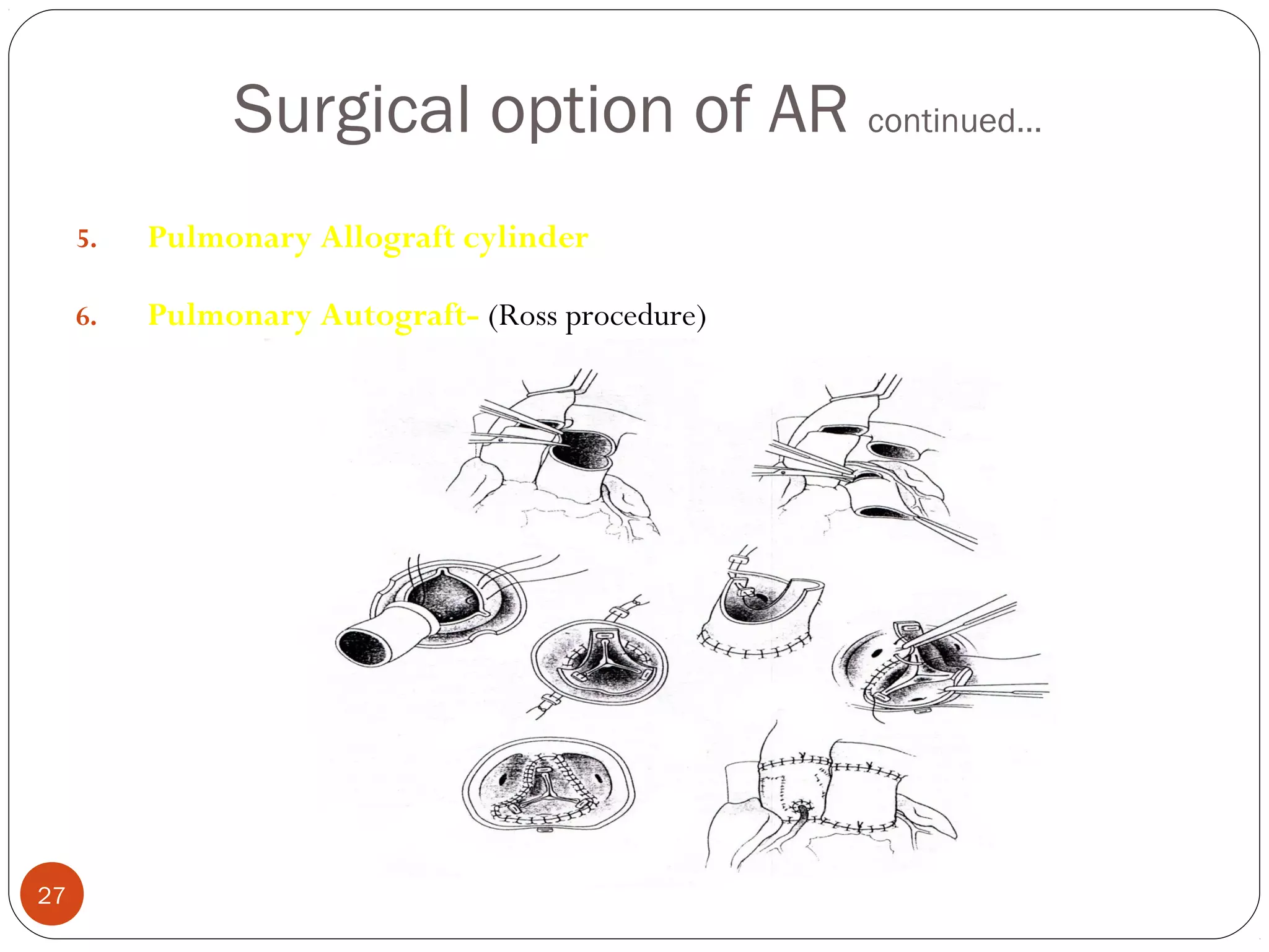 Surgical option of AR continued…
     5.   Pulmonary Allograft cylinder

     6.   Pulmonary Autograft- (Ross procedure)




27
 