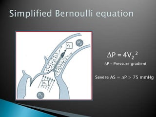 Simplified Bernoulli equationP = 4V2 2P – Pressure gradientSevere AS = P > 75 mmHg