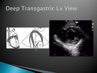 Deep Transgastric Lx View