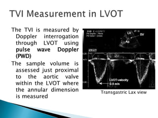 The TVI is measured by Doppler interrogation through LVOT using pulse wave Doppler (PWD) The sample volume is assessed just proximal to the aortic valve   within the LVOT where the annular dimension is measuredTVI Measurement in LVOT Transgastric Lax view