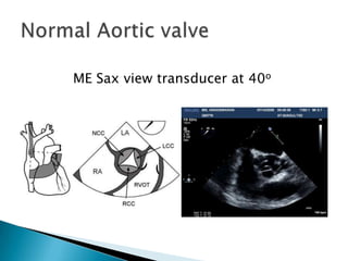 Normal Aortic valveME Sax view transducer at 40o