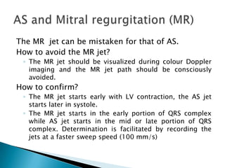The MR  jet can be mistaken for that of AS. How to avoid the MR jet?  The MR jet should be visualized during colour Doppler imaging and the MR jet path should be consciously avoided. How to confirm?The MR jet starts early with LV contraction, the AS jet starts later in systole. The MR jet starts in the early portion of QRS complex while AS jet starts in the mid or late portion of QRS complex. Determination is facilitated by recording the jets at a faster sweep speed (100 mm/s)AS and Mitral regurgitation (MR)