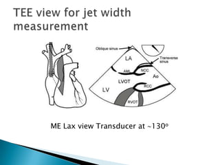 TEE view for jet width measurementME Lax view Transducer at 130o