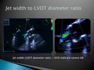 Jet width to LVOT diameter ratio Jet width-LVOT diameter ratio > 65% indicate severe AR