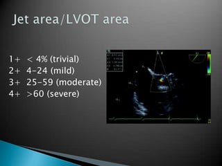 1+  < 4% (trivial)2+  4-24 (mild) 3+  25-59 (moderate) 4+  >60 (severe)Jet area/LVOT area