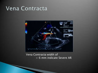 Vena ContractaVena Contracta width of	> 6 mm indicate Severe AR