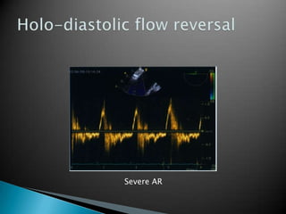 Holo-diastolic flow reversalSevere AR