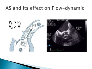 AS and its effect on Flow-dynamicP1 > P2V2 > V1