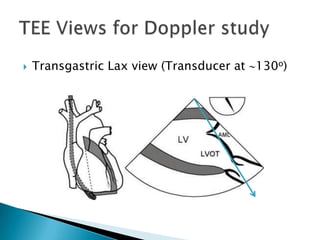 Transgastric Lax view (Transducer at 130o)TEE Views for Doppler study 