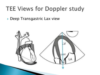 Deep Transgastric Lax viewTEE Views for Doppler study 