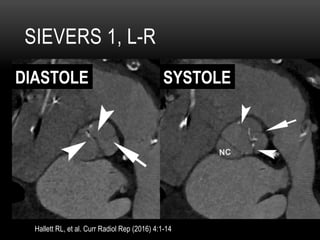 SIEVERS 1, L-R
Hallett RL, et al. Curr Radiol Rep (2016) 4:1-14
DIASTOLE SYSTOLE
 
