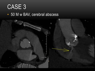 CASE 3
•  50 M w BAV, cerebral abscess
 