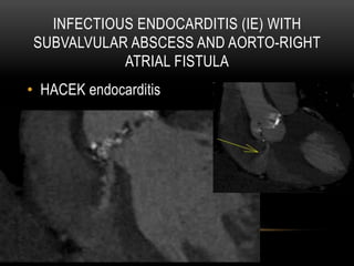 INFECTIOUS ENDOCARDITIS (IE) WITH
SUBVALVULAR ABSCESS AND AORTO-RIGHT
ATRIAL FISTULA
•  HACEK endocarditis
 