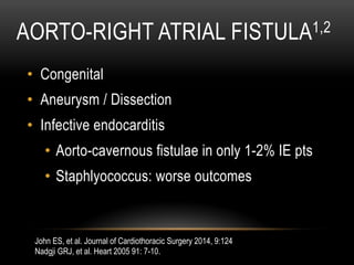 AORTO-RIGHT ATRIAL FISTULA1,2
•  Congenital
•  Aneurysm / Dissection
•  Infective endocarditis
•  Aorto-cavernous fistulae in only 1-2% IE pts
•  Staphlyococcus: worse outcomes
John ES, et al. Journal of Cardiothoracic Surgery 2014, 9:124
Nadgji GRJ, et al. Heart 2005 91: 7-10.
 