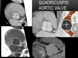 QUADRICUSPID
AORTIC VALVE
 
