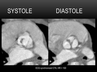 SYSTOLE DIASTOLE
ECG synchronized CTA, HR > 100
 