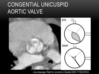CONGENTIAL UNICUSPID
AORTIC VALVE
SYS
DIAST
Line drawings: Petit CJ, et al Am J Cardiol 2016; 117(6) 972-9.
 