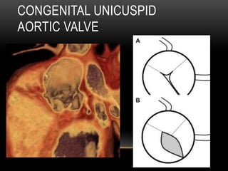 CONGENITAL UNICUSPID
AORTIC VALVE
 