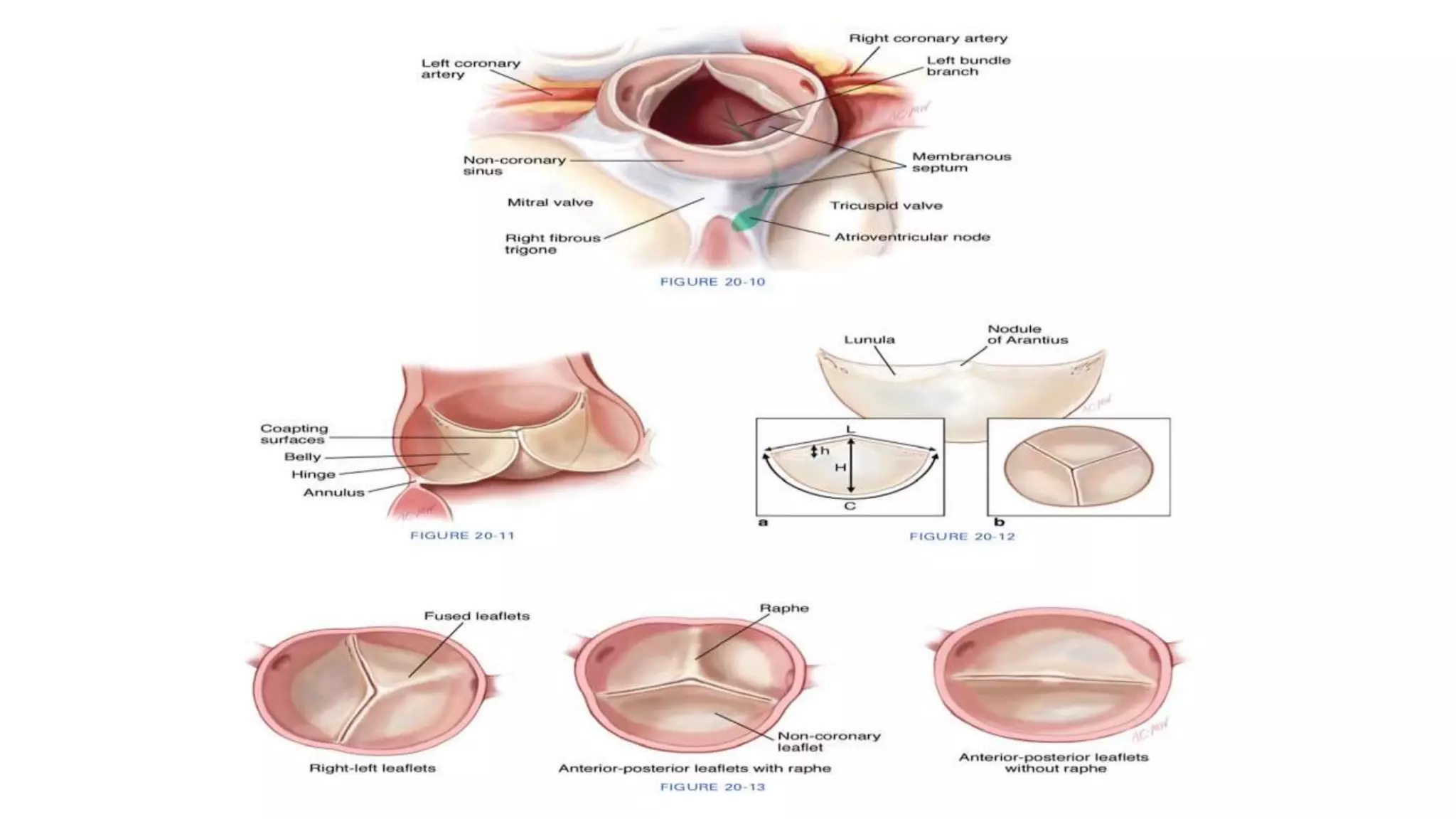 Aortic valve disease | PPTX