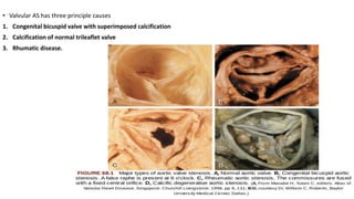 • Valvular AS has three principle causes
1. Congenital bicuspid valve with superimposed calcification
2. Calcification of normal trileaflet valve
3. Rhumatic disease.
 