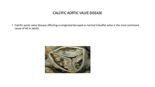 CALCIFIC AORTIC VALVE DISEASE
• Calcific aortic valve disease affecting a congenital bicuspid or normal trileaflet valve is the most commone
cause of AS in adults
 