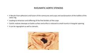 RHEUMATIC AORTIC STENOSIS
• It Results from adhesions and fusion of the comissures and cusps and vasclarazation of the leaflets of the
valve ring
• Leading to retraction and stiffening of the free borders of the cusps
• Calcific nodules deveope on bothe surface and orifice is reduced to small round or triangular opening.
• It can be regurgitant as well as stenotic.
 