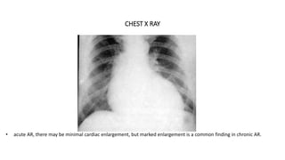 CHEST X RAY
• acute AR, there may be minimal cardiac enlargement, but marked enlargement is a common finding in chronic AR.
 