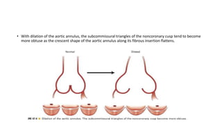 • With dilation of the aortic annulus, the subcommissural triangles of the noncoronary cusp tend to become
more obtuse as the crescent shape of the aortic annulus along its fibrous insertion flattens.
 