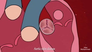 Irfan
Mohammed
Aortic valve disease
 
