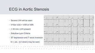 ECG in Aortic Stenosis
• Severe LVH will be seen
• V1Sor V2S + V5R or V6R
• > 35 mm, LVH present
• Sokolow-Lyon Criteria
• ST depression and T wave inversion
In I, avL (LV strain) may be seen.
 