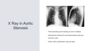X Ray in Aortic
Stenosis
• The Ascending aorta leading to arch is dilated,
• whereas the distal arch and descending aorta are
normal in size.
• Aortic valve calcification may be seen.
 