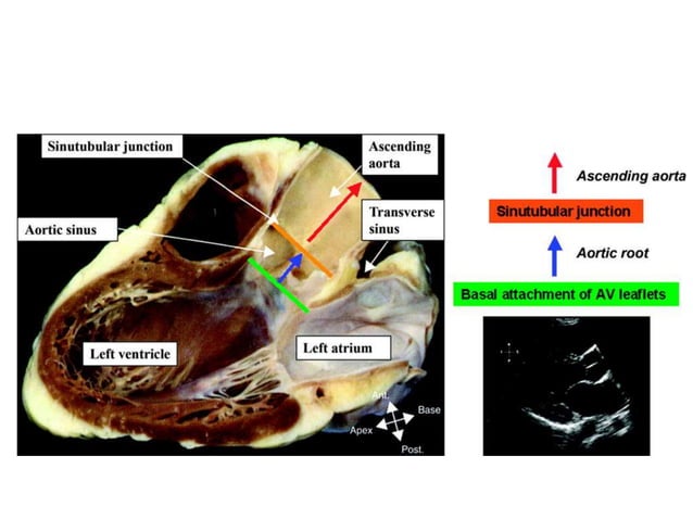 Aortic valve anatomy presentation | PPTX | Heart and Cardiovascular ...