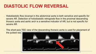 DIASTOLIC FLOW REVERSAL
Holodiastolic flow reversal in the abdominal aorta is both sensitive and specific for
severe AR. Detection of holodiastolic retrograde flow in the proximal descending
thoracic aorta and aortic arch is a sensitive indicator of AR, but is not specific for
severe AR.
The short-axis TEE view of the descending thoracic aorta is used for placement of
the pulsed wave sample volume distal in the aorta, near the diaphragm.
 