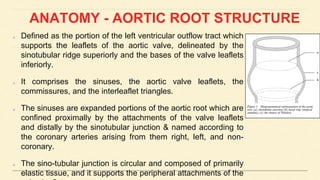 ANATOMY - AORTIC ROOT STRUCTURE
Defined as the portion of the left ventricular outflow tract which
supports the leaflets of the aortic valve, delineated by the
sinotubular ridge superiorly and the bases of the valve leaflets
inferiorly.
It comprises the sinuses, the aortic valve leaflets, the
commissures, and the interleaflet triangles.
The sinuses are expanded portions of the aortic root which are
confined proximally by the attachments of the valve leaflets
and distally by the sinotubular junction & named according to
the coronary arteries arising from them right, left, and non-
coronary.
The sino-tubular junction is circular and composed of primarily
elastic tissue, and it supports the peripheral attachments of the
 