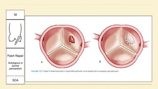 Aortic valve Repair & Replacement.TEEpptx