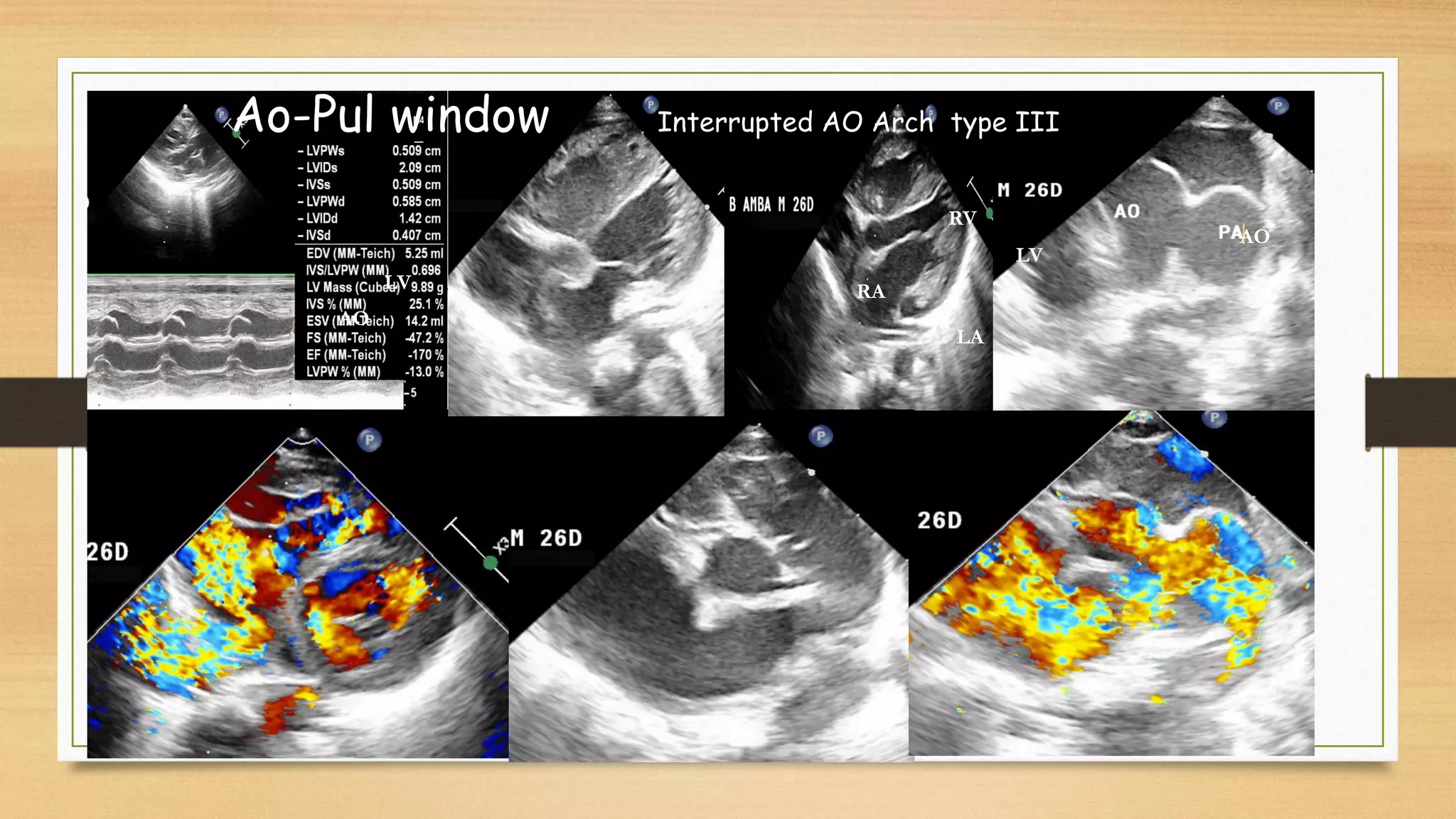 Aortogene Panel Aorto pulmonary window may 2021 | PDF