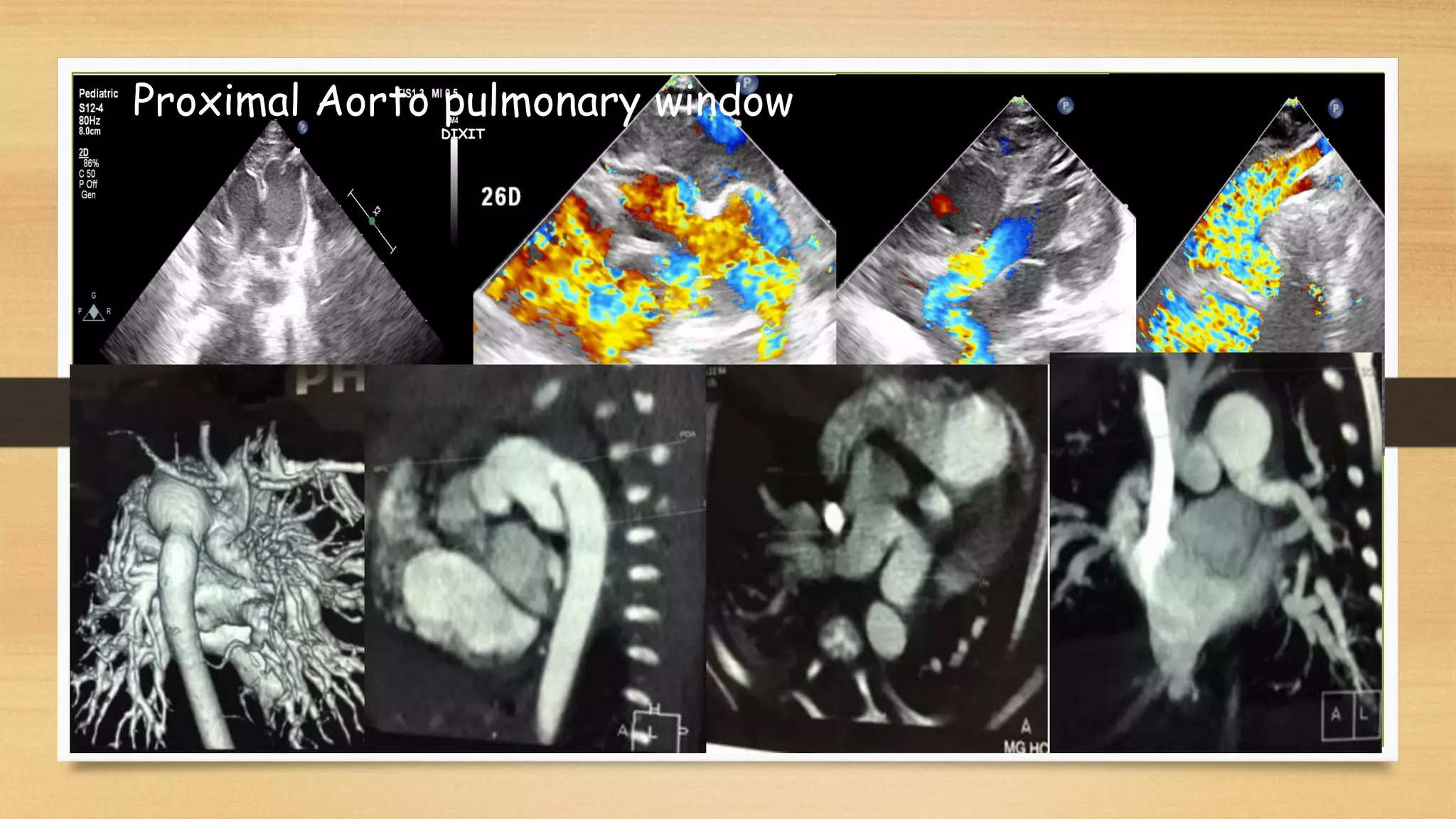 Aortogene Panel Aorto pulmonary window may 2021 | PDF
