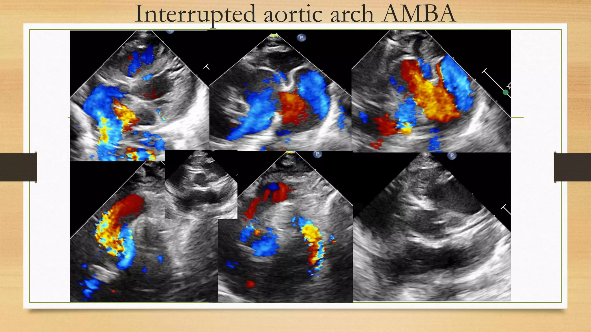 Aortogene Panel Aorto pulmonary window may 2021 | PDF