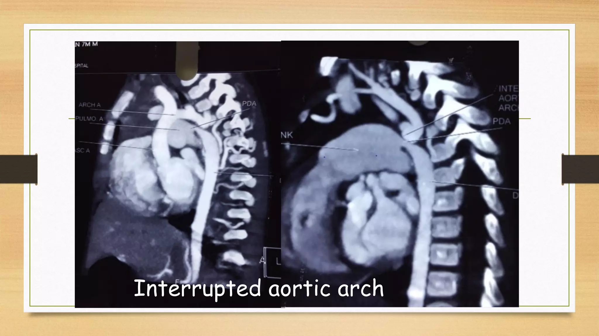 Aortogene Panel Aorto pulmonary window may 2021 | PDF