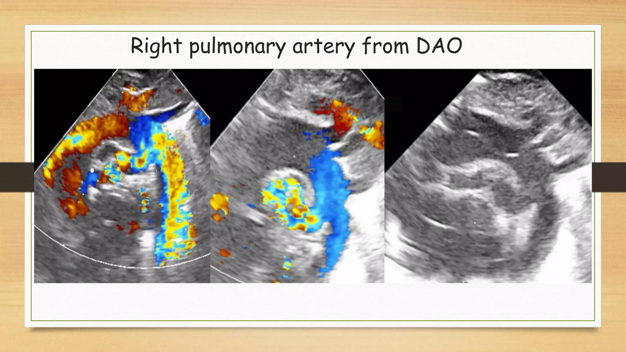 Aortogene Panel Aorto pulmonary window may 2021 | PDF