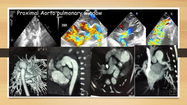 Aorto pulmonary window may 2021 | PDF | Heart and Cardiovascular ...