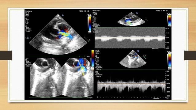 Aorto pulmonary window may 2021 | PDF | Heart and Cardiovascular ...