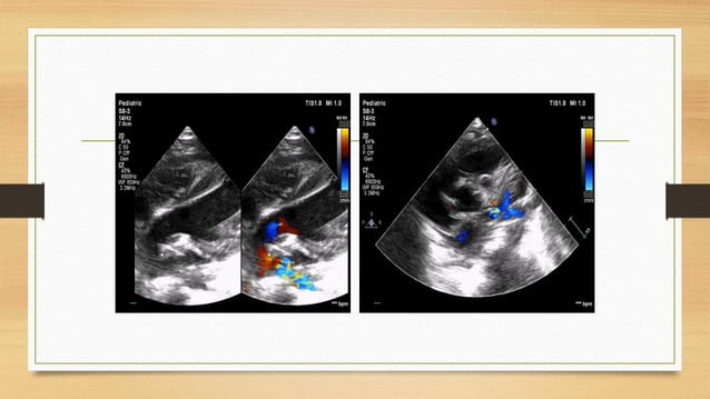 Aortogene Panel Aorto pulmonary window may 2021 | PDF | Heart and Cardiovascular ...