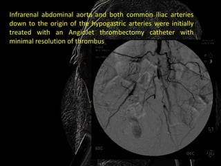 Infrarenal abdominal aorta and both common iliac arteries
down to the origin of the hypogastric arteries were initially
treated with an AngioJet thrombectomy catheter with
minimal resolution of thrombus
 