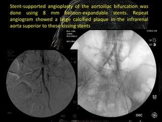 Stent-supported angioplasty of the aortoiliac bifurcation was
done using 8 mm balloon-expandable stents. Repeat
angiogram showed a large calcified plaque in the infrarenal
aorta superior to these kissing stents
 