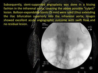 Subsequently, stent-supported angioplasty was done in a kissing
fashion in the infrarenal aorta, covering the above possible “culprit”
lesion. Balloon-expandable stents (9 mm) were used (thus extending
the iliac bifurcation superiorly into the infrarenal aorta; images
showed excellent acute angiographic outcome with swift flow and
no residual lesion.
 