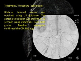 Treatment / Procedure (continued)

Bilateral    femoral    access    was
obtained using US guidance. The
aortoiliac occlusion was crossed in 10
seconds using glidewires from both
groins.       Baseline     angiogram
confirmed the CTA findings
 