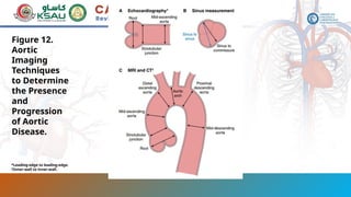Aortopathy and guidelinesFI PPT 2025.pptx