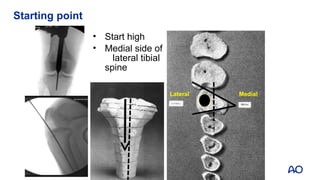 Tibia Starting View AOT_Adv_Tibial_shaft_fx_FINAL2019 (1).ppt